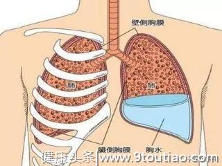 胸部久痛不管，到医院抽两斤血水，一查肺癌晚期，所幸能吃靶向药