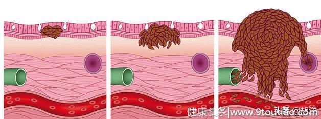 胸部久痛不管，到医院抽两斤血水，一查肺癌晚期，所幸能吃靶向药