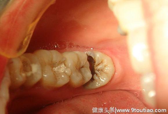 虫牙就是牙里长虫吗？为什么到疼痛后才会发现？