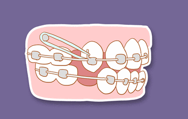 牙齿矫正的流程是什么？