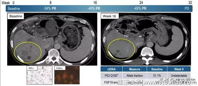 控制率68%！抗癌新药BLU-554给晚期肝癌患者带来更多生存希望！