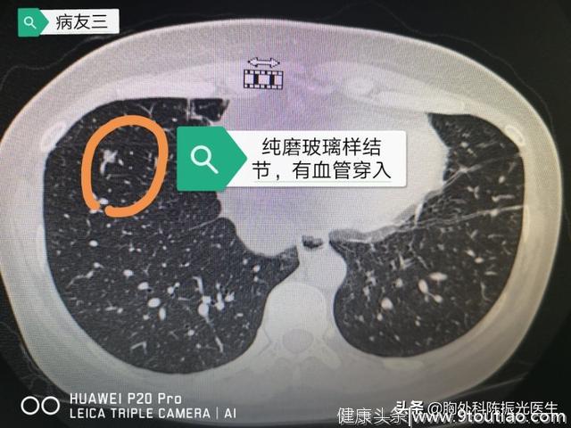 体检发现肺部结节=肺癌？先别自己吓自己