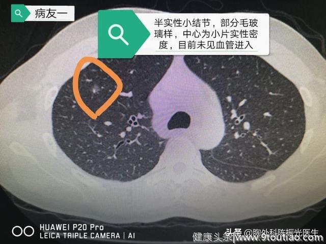 体检发现肺部结节=肺癌？先别自己吓自己