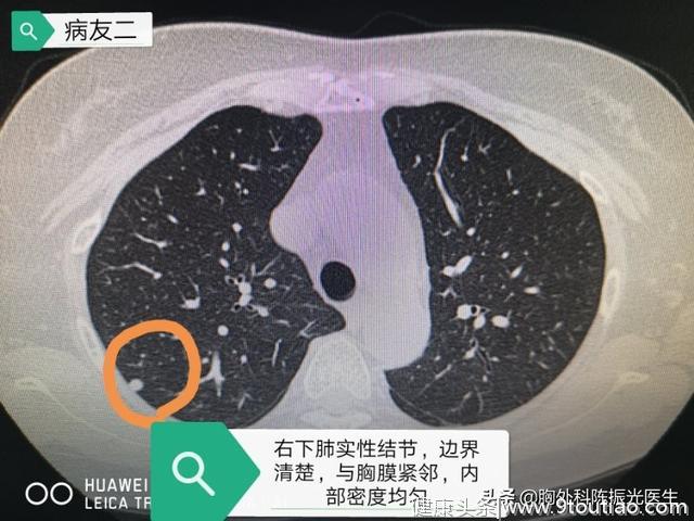 体检发现肺部结节=肺癌？先别自己吓自己