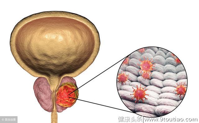 怎么辨别前列腺炎前列腺增生与前列腺癌？从这7点了解它们的不同