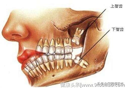 拔智齿是不是很疼?会不会特别血腥？