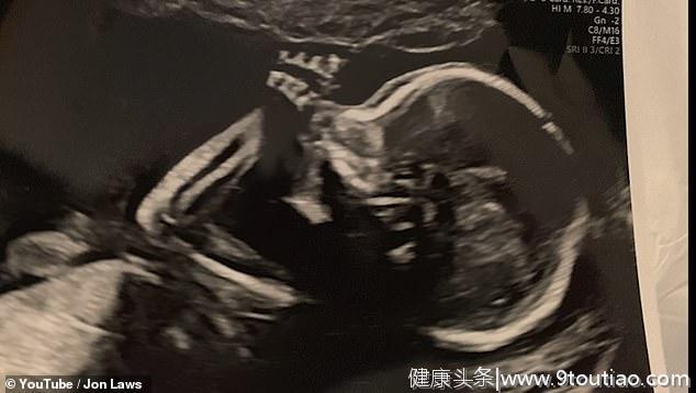 中国女子与美国丈夫结婚三年未孕，靠试管受精成功怀孕后喜极而泣