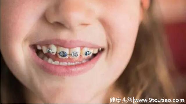 儿童矫正牙齿的最佳时机，你错过了吗？
