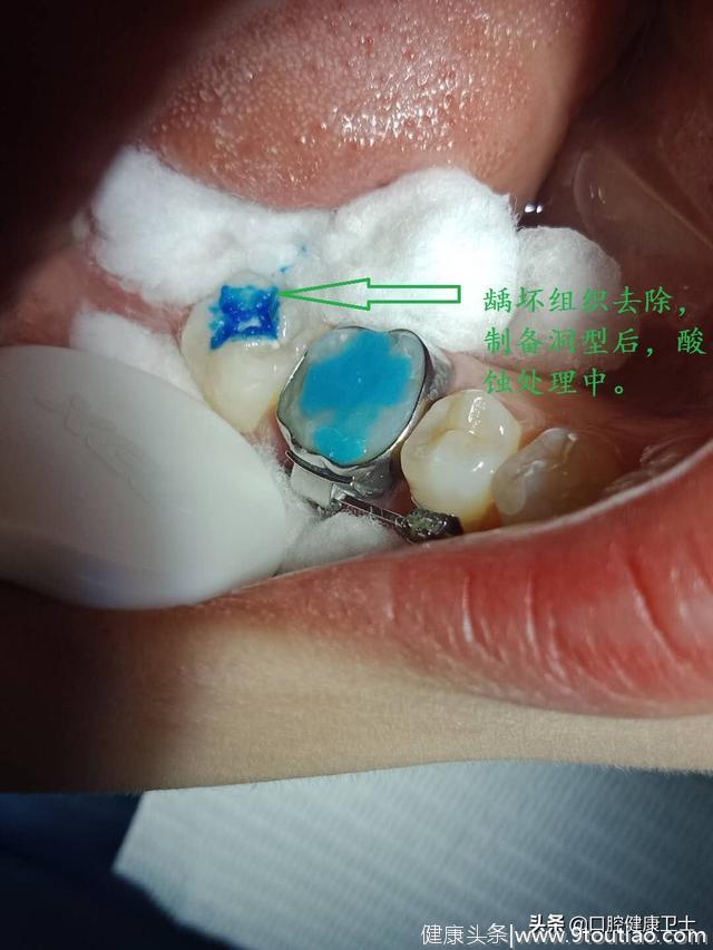 矫正牙半年后，牙面上突然出现了黑点，当心这种口腔常见病！