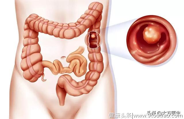 长在肠管内面的“肉疙瘩”，多数肠癌都因它而发生，你中招没？