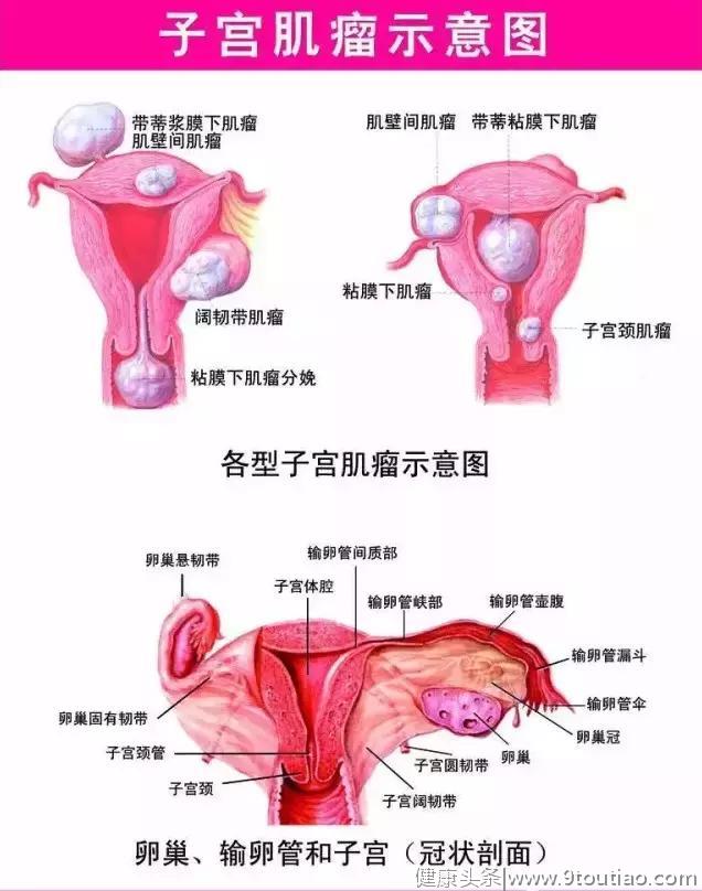 子宫肌瘤怎么形成的？