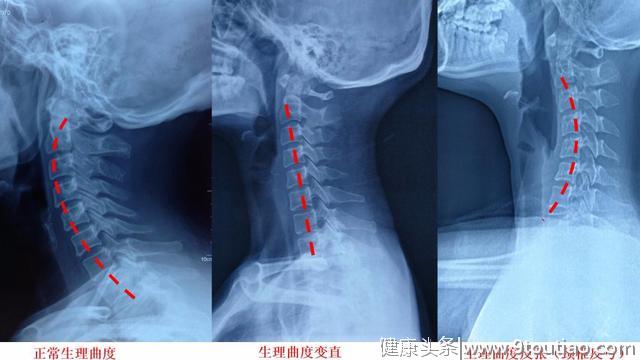 颈椎反弓或颈椎变直，恢复矫正方案