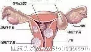 为什么很多女性都会得子宫肌瘤？怎么来的？女性朋友必看……