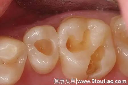 五岁小朋友患蛀牙，其母说：孩子乳牙不用补？反正迟早都要换！