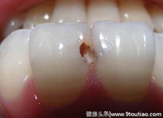 五岁小朋友患蛀牙，其母说：孩子乳牙不用补？反正迟早都要换！