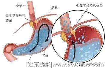 去看病说是胃源性哮喘？胃源性哮喘应该怎么办？