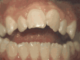 如果你的牙齿有以下这些情况，那你就真的需要做矫正了！