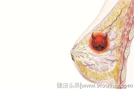 女子注重保健，定期超声检查未见癌灶，核磁检查却是乳腺癌？