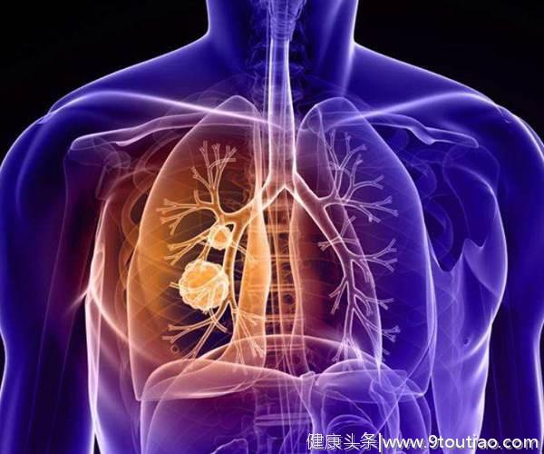 55岁女子生活习惯良好却被查出肺癌，原来和“三霾五气”有关！