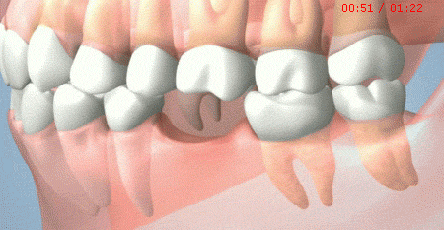 牙齿缺失不补的危害