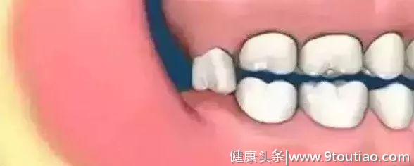 口腔系列之智齿：智齿该不该拔？拔除后有什么影响？怎么恢复？
