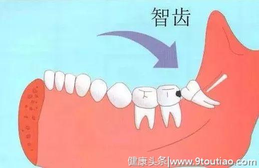 口腔系列之智齿：智齿该不该拔？拔除后有什么影响？怎么恢复？