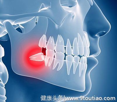 口腔系列之智齿：智齿该不该拔？拔除后有什么影响？怎么恢复？