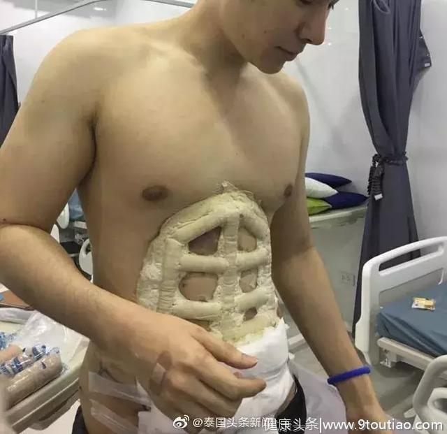 快速拥有6块腹肌！泰国一男子做手术“雕刻”出6块腹肌