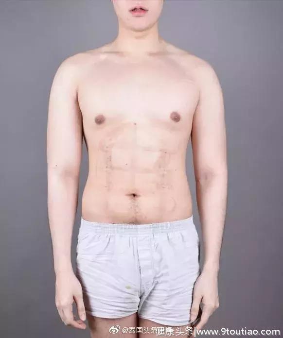 快速拥有6块腹肌！泰国一男子做手术“雕刻”出6块腹肌