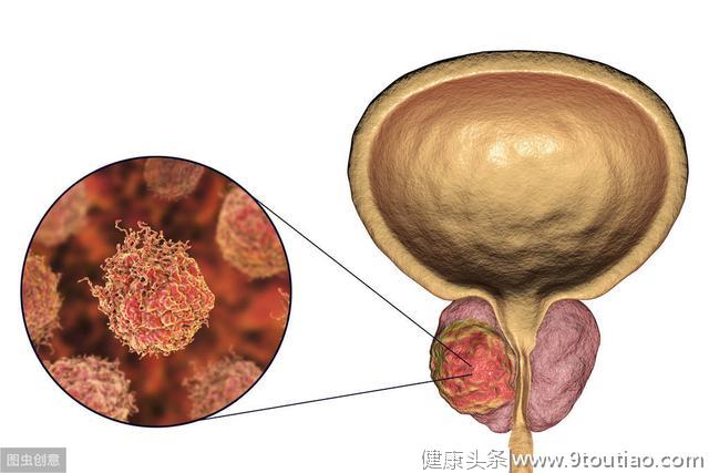 为何说前列腺有4怪8怕？中青年防治疗前列腺疾病9误区和3要4不要