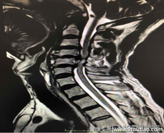普医首例颈椎后路单开门椎管扩大成形术成功开展