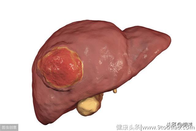 小伙迷信验血，甲胎蛋白未升高以为不会得肝癌，三个月后肝癌晚期