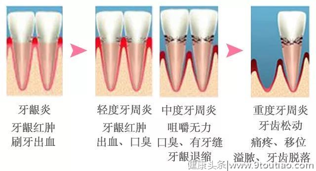 了解箍牙始末，揭开口腔正畸的神秘面纱