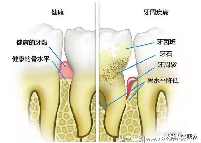 让牙齿掉光的牙周炎！该如何预防和治疗？