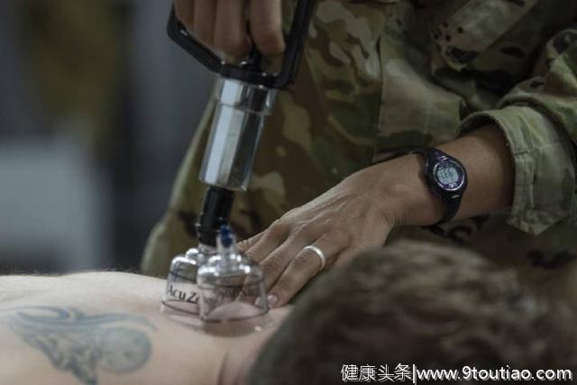 中医的针灸和拔罐技术在美军中的发展