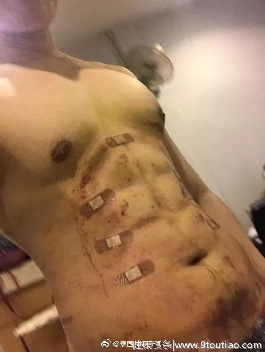 泰国男子通过手术做了六块“人造腹肌”！背后真实面目你见过吗？