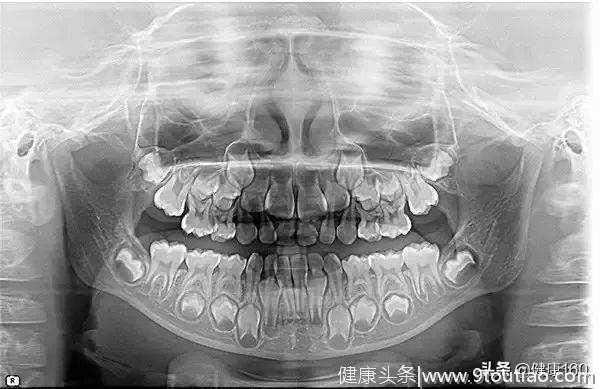 罗小医含泪告诉你：真的不是搞推销，口腔诊疗中影像检查的必要性