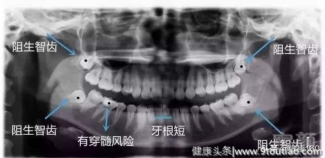 罗小医含泪告诉你：真的不是搞推销，口腔诊疗中影像检查的必要性