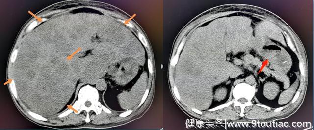 查到胃癌和8颗淋巴结转移，多亏半碗五花肉，把他撑坏了