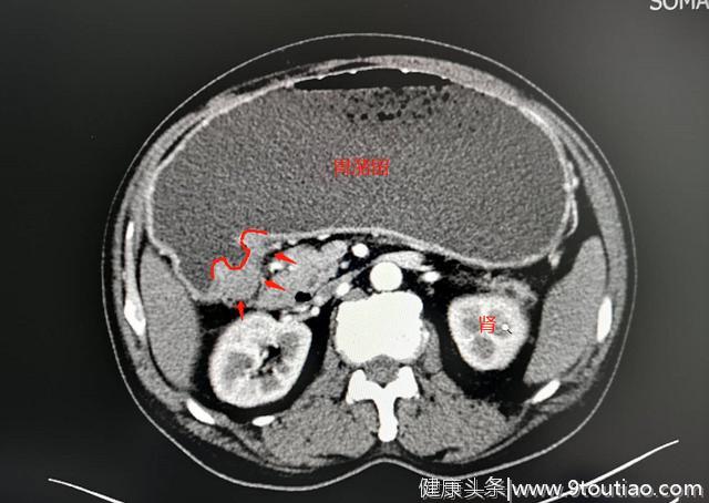 查到胃癌和8颗淋巴结转移，多亏半碗五花肉，把他撑坏了