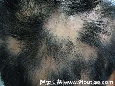 头皮瘙痒可能引起脱发，主要因为八种原因引起，要对症防治。