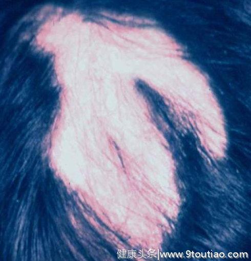 头皮瘙痒可能引起脱发，主要因为八种原因引起，要对症防治。