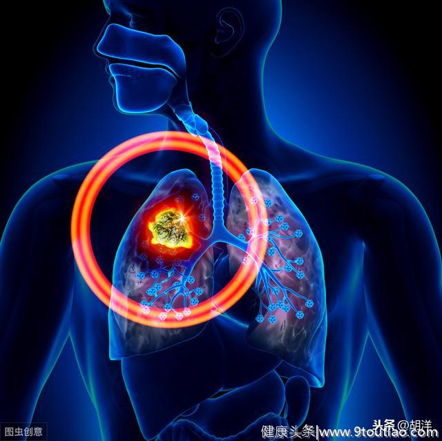肺部结节的本质原来是这个，肺癌只是其中之一，大部分不用担心