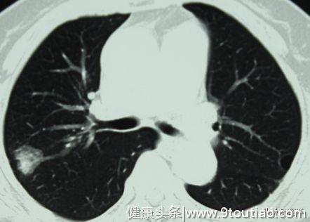 肺部结节的本质原来是这个，肺癌只是其中之一，大部分不用担心