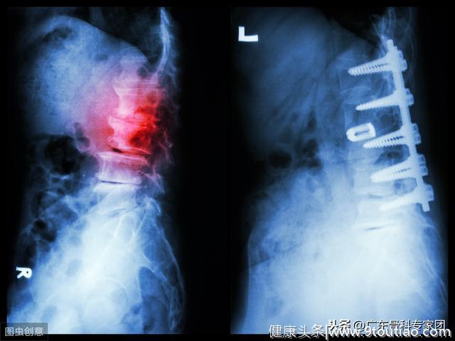 哪些颈椎病患者不建议手术？医生的建议请仔细记好