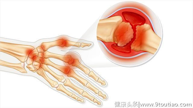 类风湿性关节炎症状：你的手是这种感觉么？如果是，请小心！