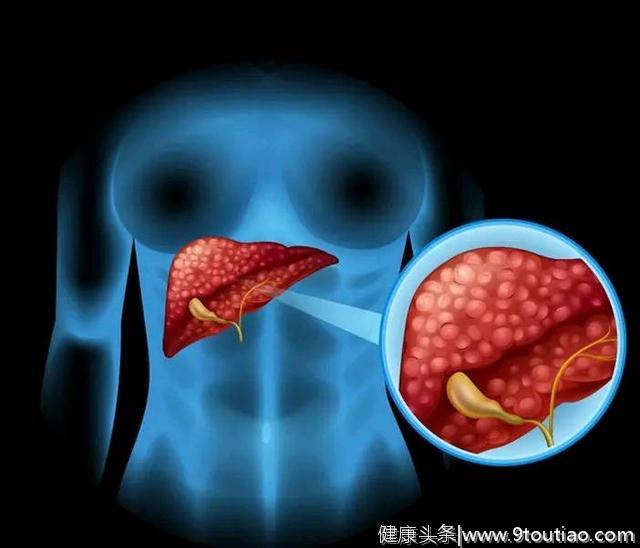 忠告:四种食物易“招惹”肝癌，想要有颗健康的肝脏，必须管住嘴