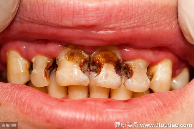 为什么你的牙齿越来越黑？主要和这5个原因有关
