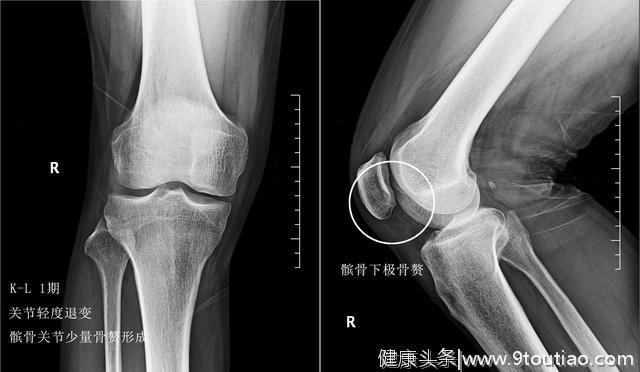 如果没有核磁，医生仅依靠X光能判断膝关节骨关节炎的病情吗？