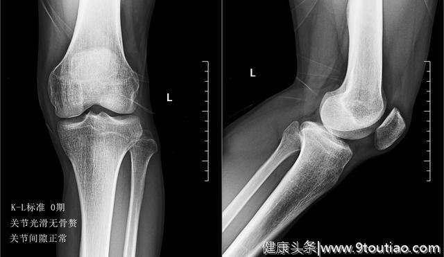 如果没有核磁，医生仅依靠X光能判断膝关节骨关节炎的病情吗？